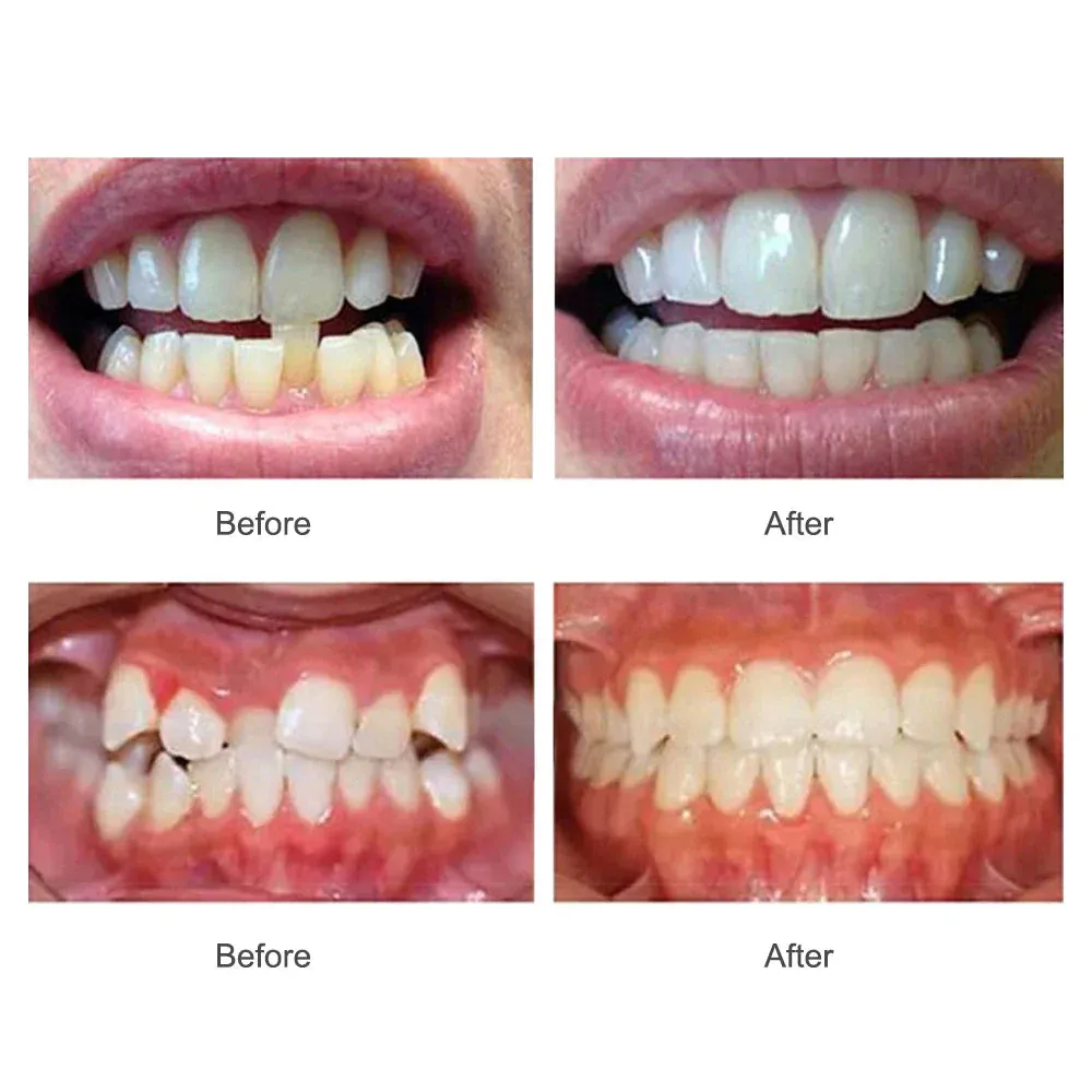 Adult Dental Braces Trainer for Teeth Alignment
